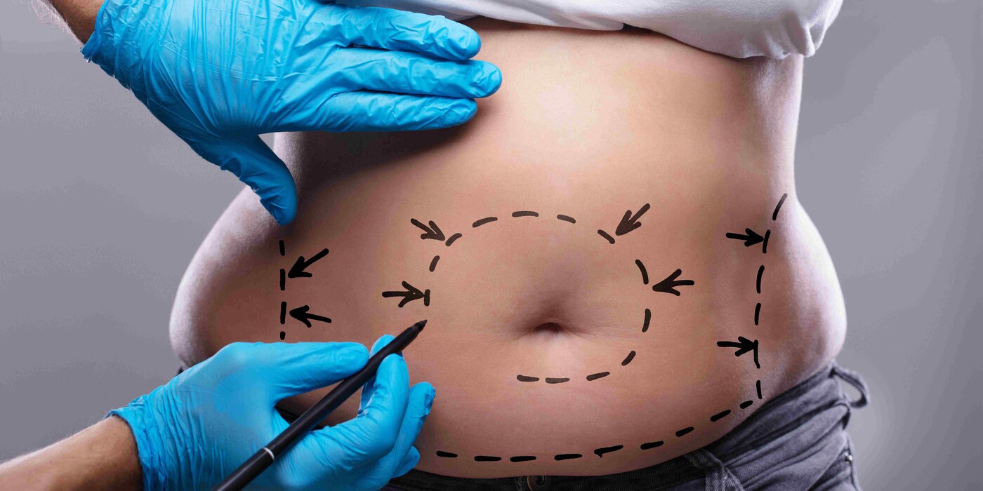 Considering a Tummy Tuck? Here's What You Need to Know | Duke Health